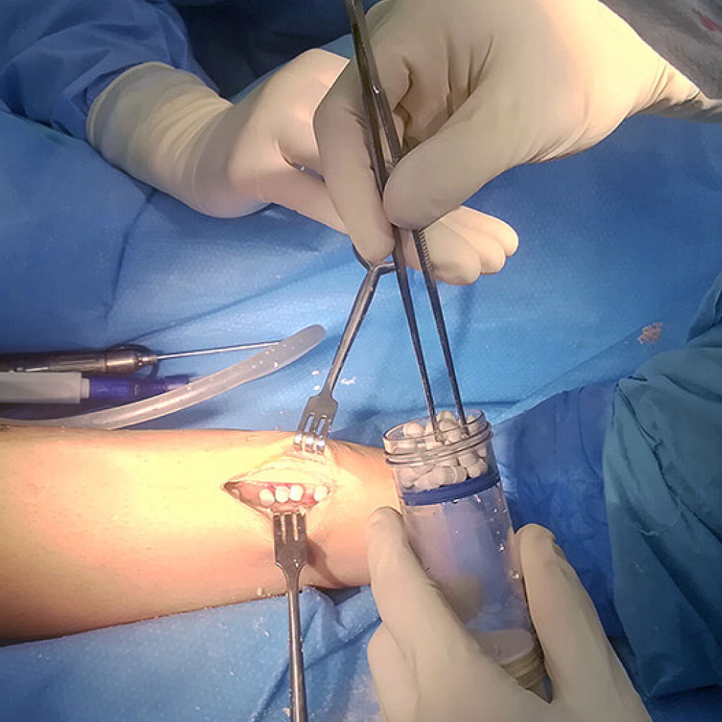 Perinfections Perossal